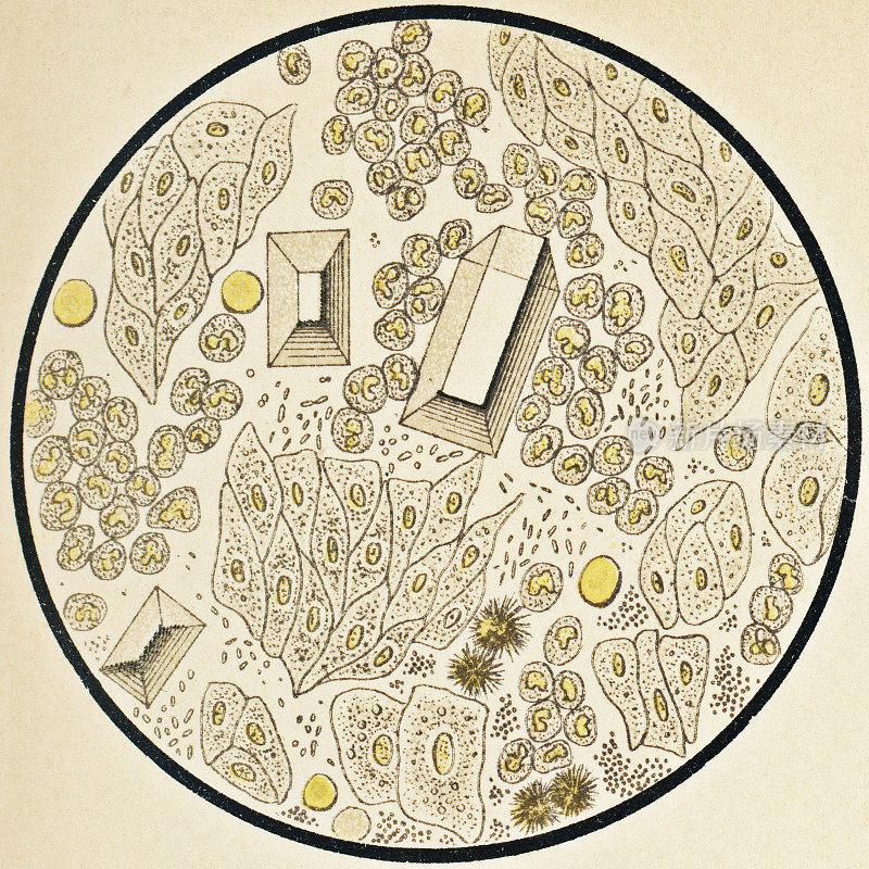 从膀胱感染病人的尿液沉淀物的显微镜观察- 19世纪